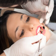 Why Root Canal Treatment is the Best Solution for Cracked Teeth
