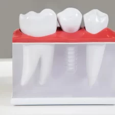 How Much Do Dental Implants Cost in Waterford, MI? Everything You Need to Know