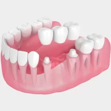 How Long Do Dental Bridges Last? Expert Guide for Waterford, MI Patients